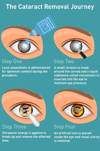 cataracts diagram